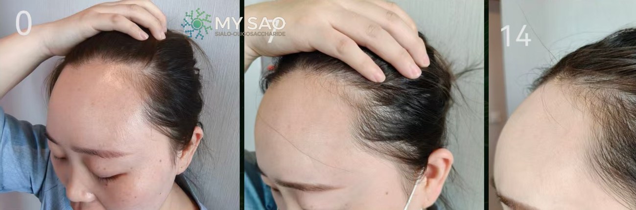 Female hairline · day 0 / 7 / 14