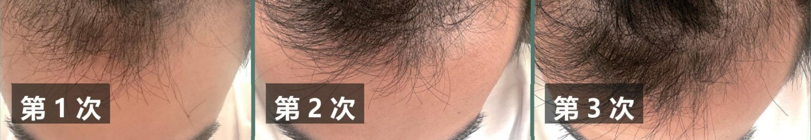 Male occiput · three visits