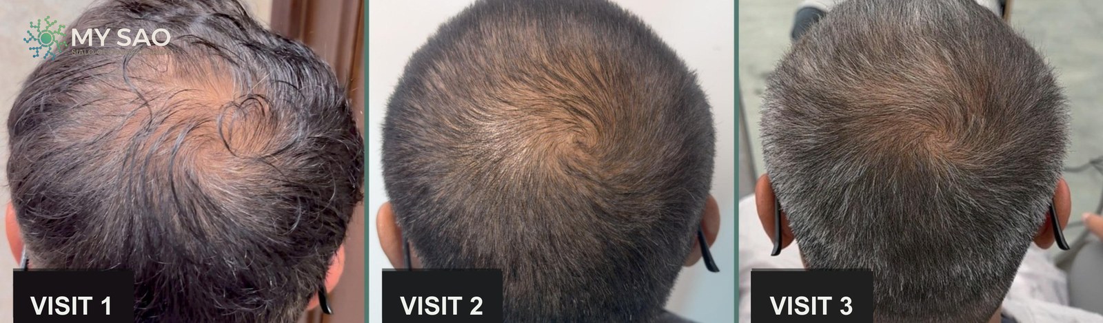 Male 45+ · occiput · three visits, 30 days apart