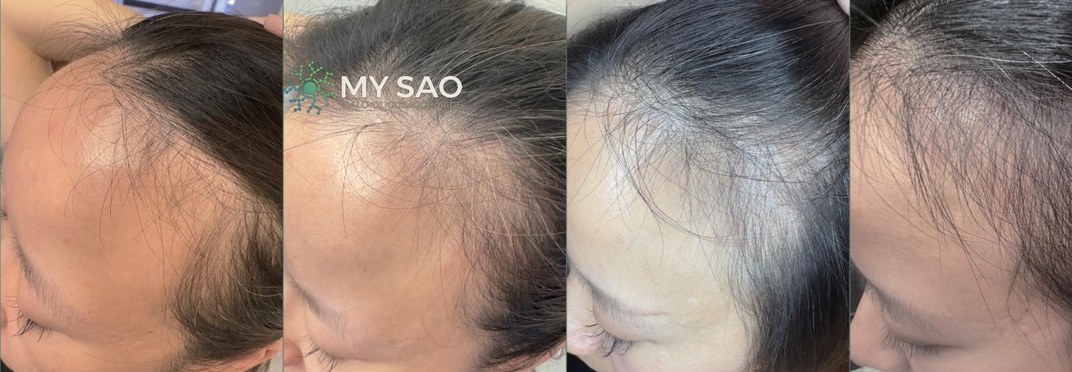 Female hairline · another user · 75 days