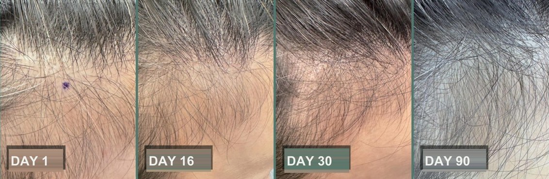 Female hairline · day 1 / 16 / 30 / 90